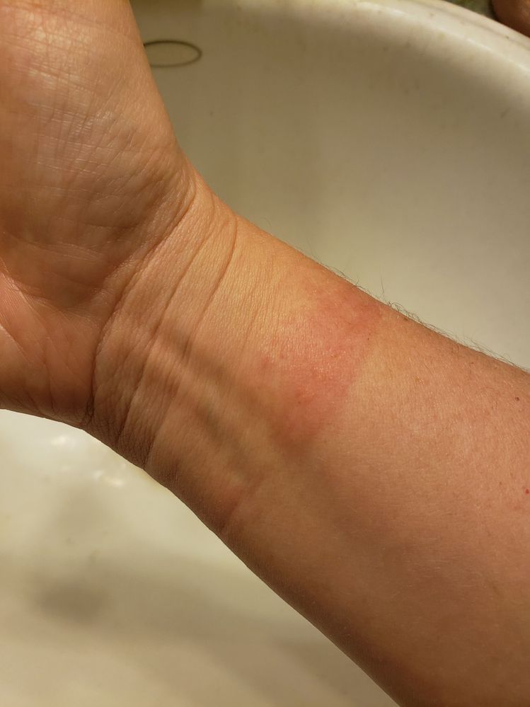 This is what the rash looks like, raised and bumpy , red  and itchy.