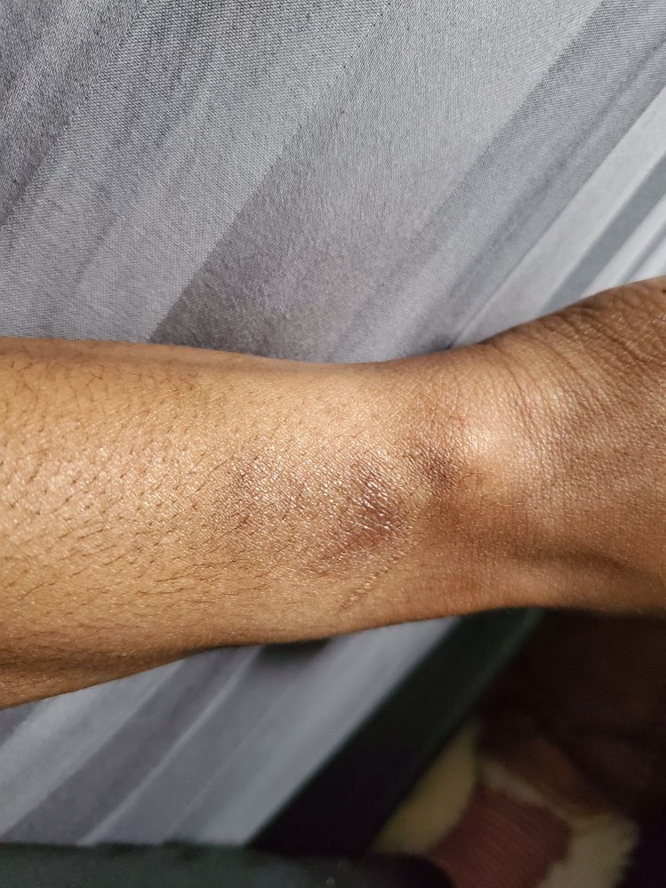 This is my  wrist i was like is this just me but i seen you guys all with problem.. they needs to do better cause not suppise to happen or was we told this