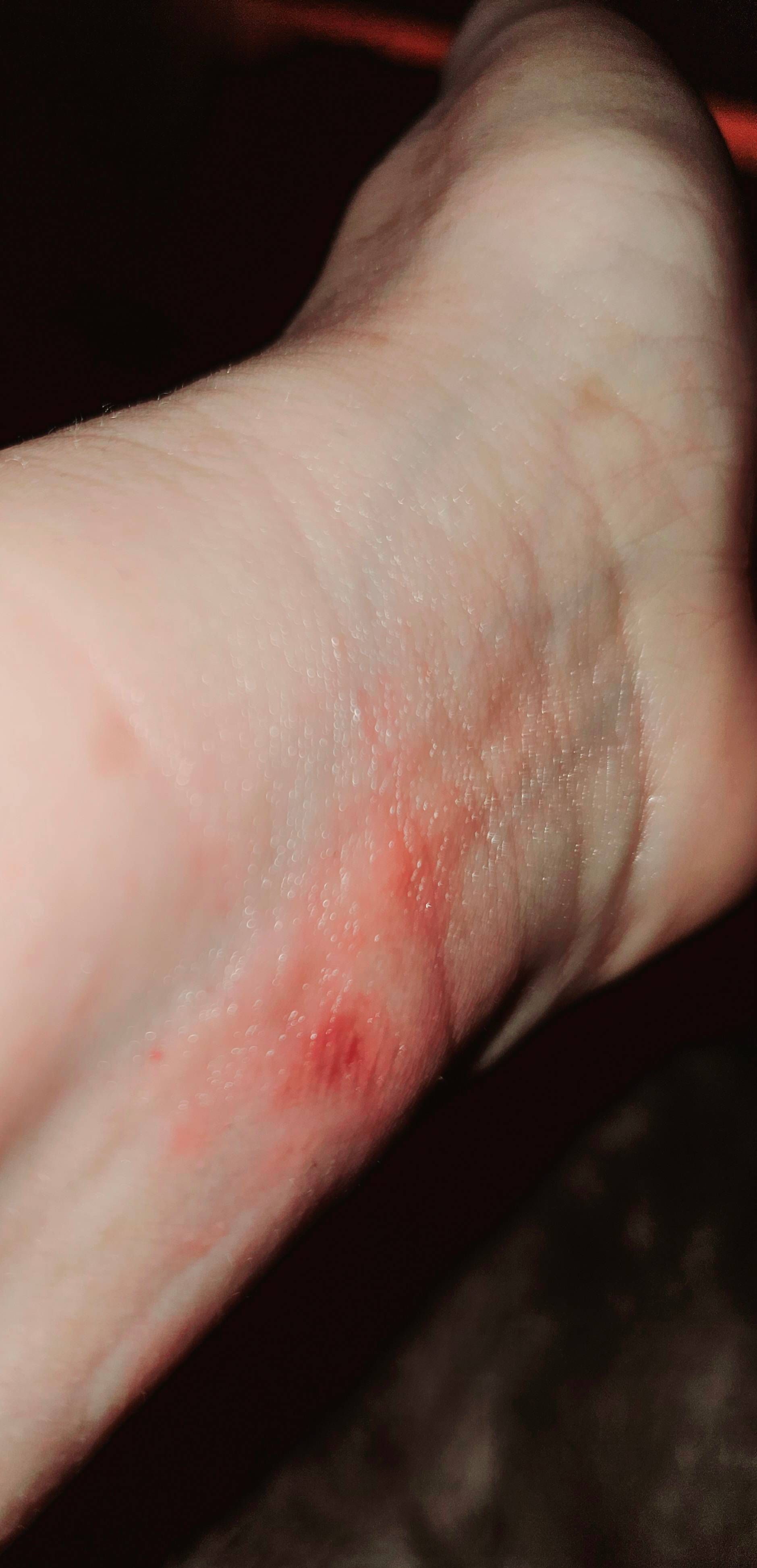 Rode vlekken door fitnessarmbandjes