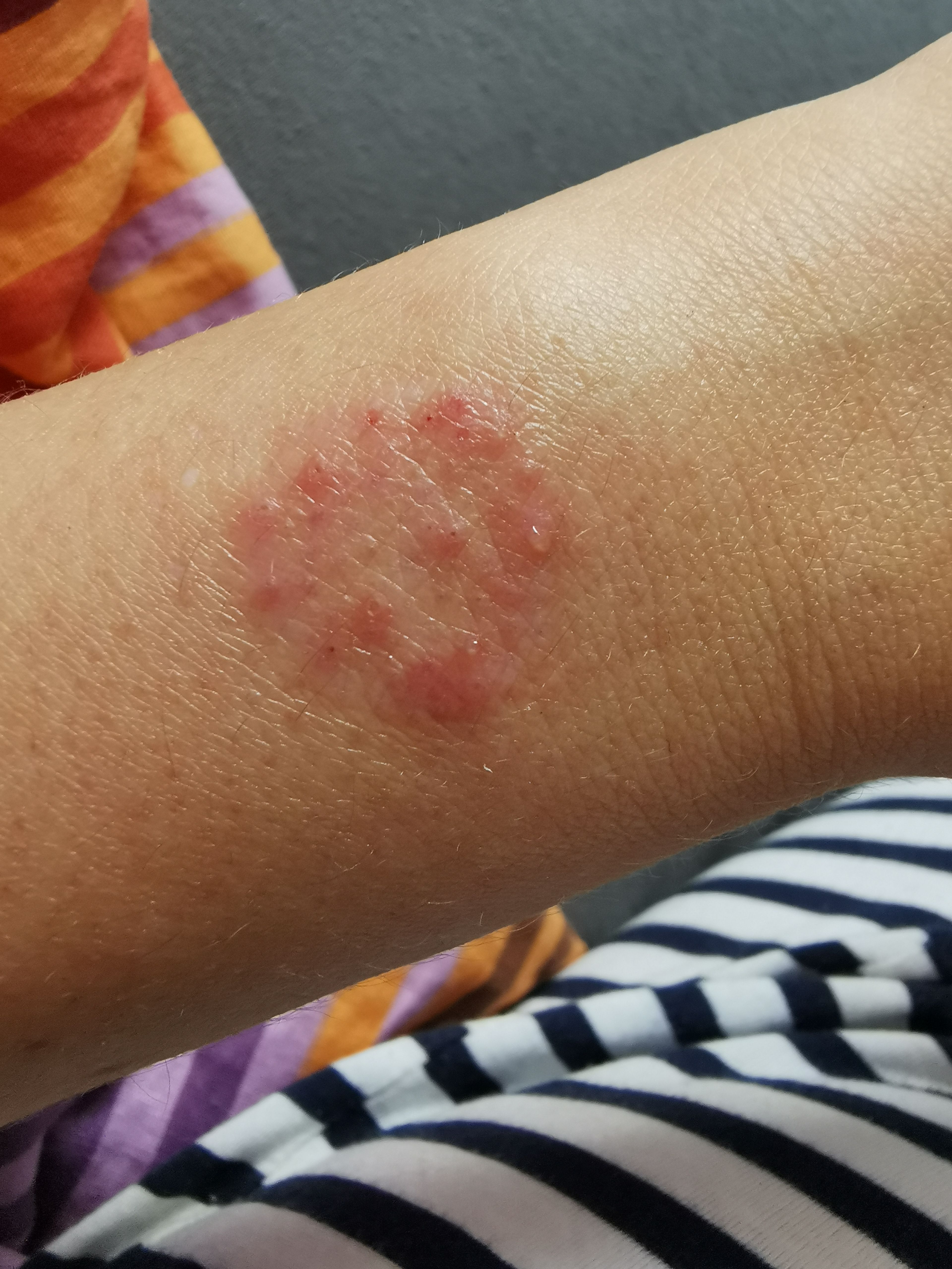 Galaxy Watch 42mm Horrible Rash Samsung Community