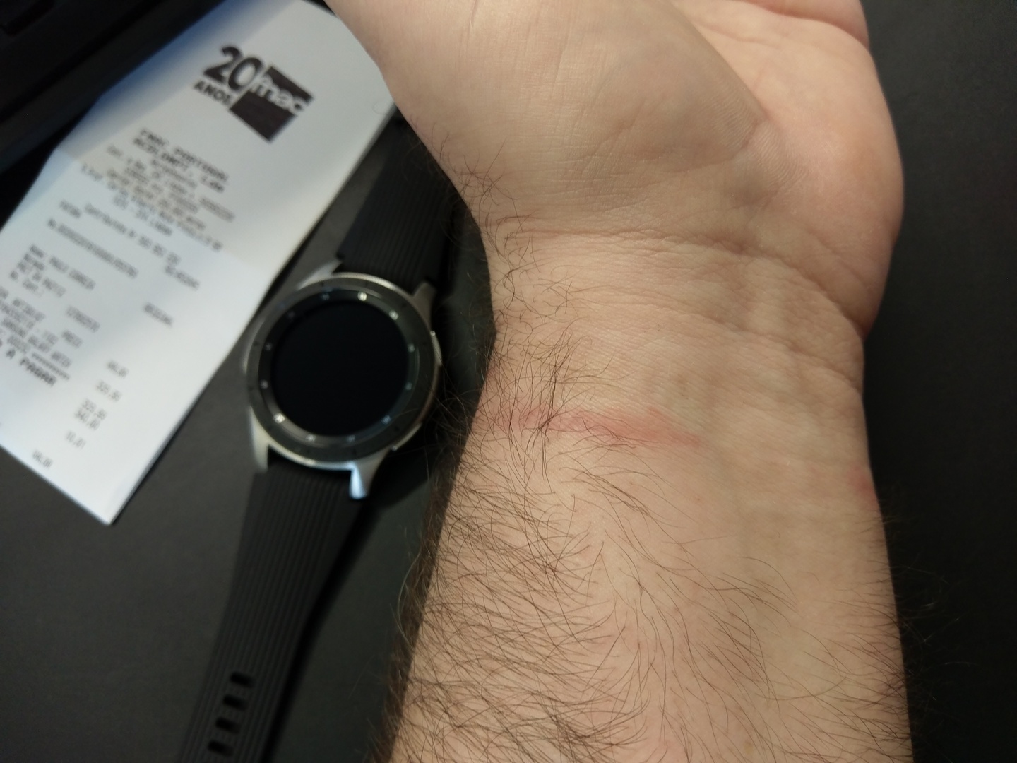 Galaxy watch rash - Page 36 - Samsung Community