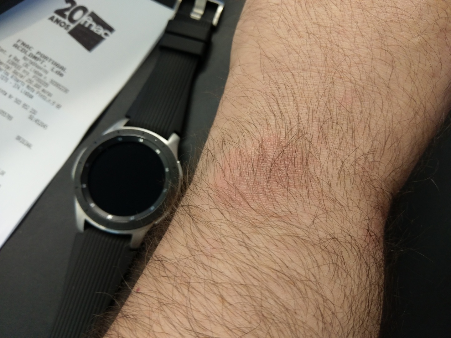 Galaxy watch rash Page 33 Samsung Community