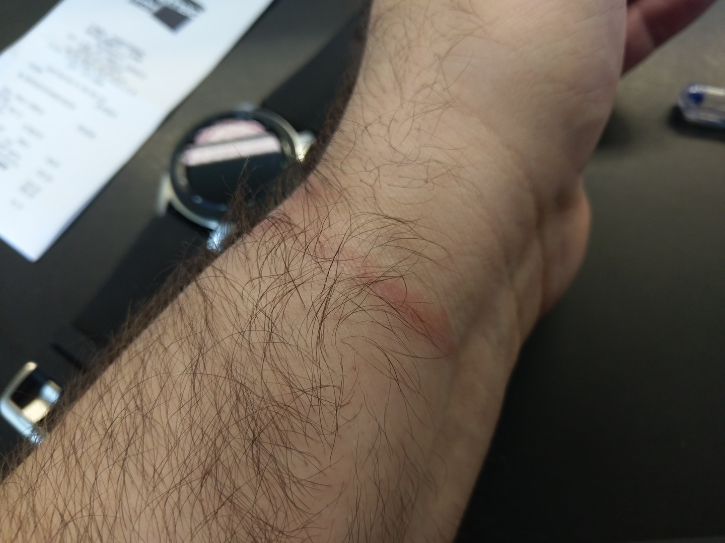 Galaxy watch rash Samsung Community