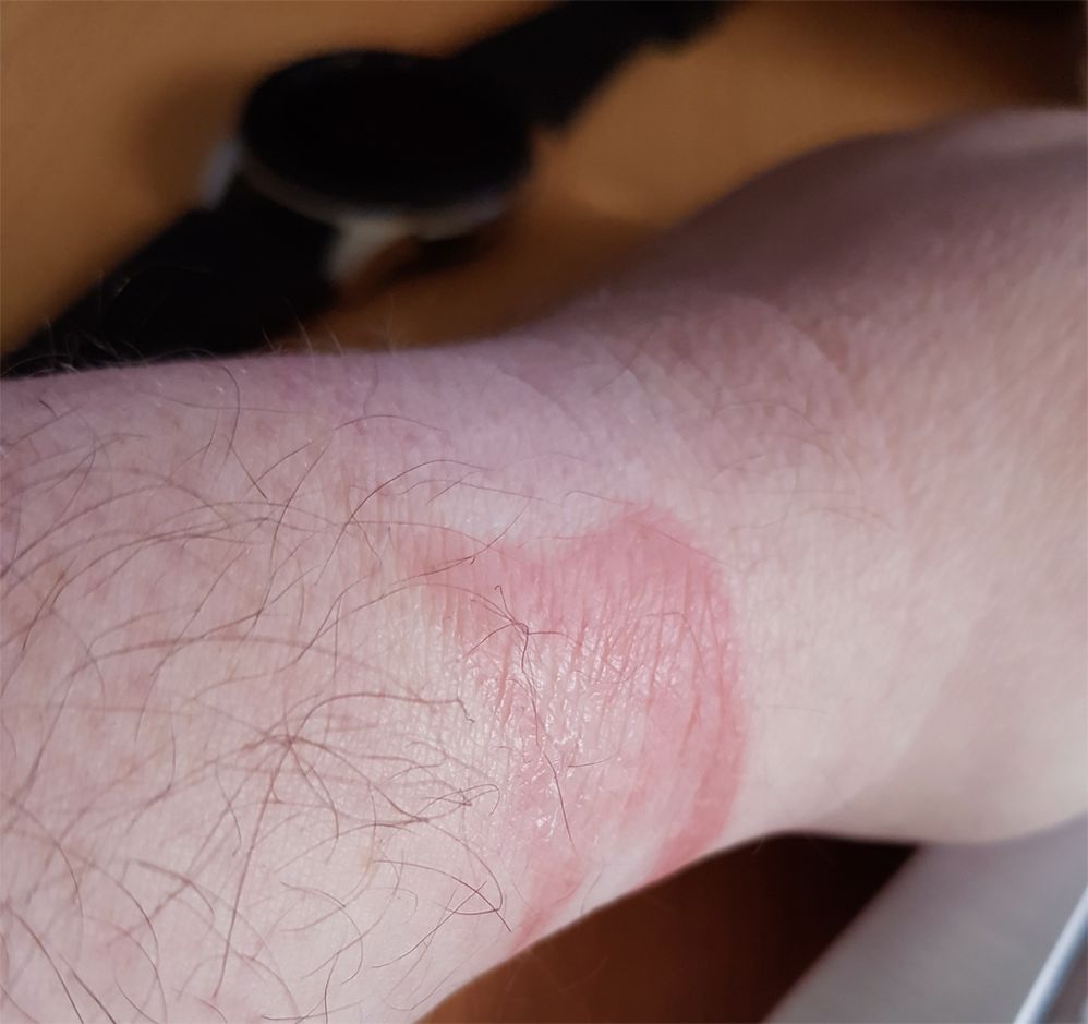 skin reacttion to lower part of strap. Upper part of wrist is the same.