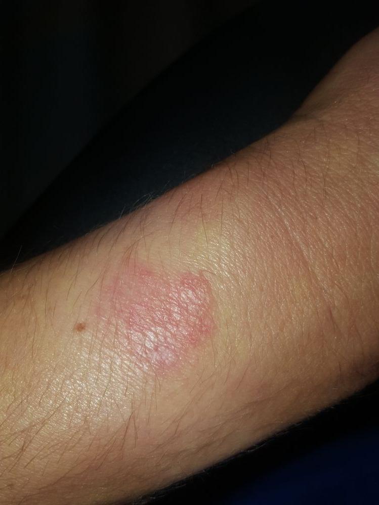 These pictures do not do my "rash" justice