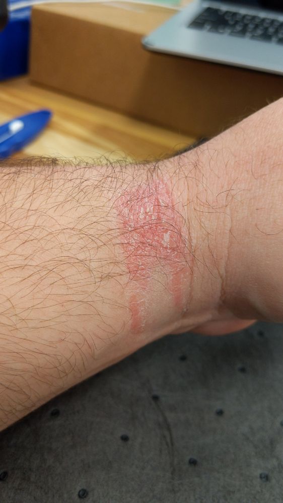 Inside of left wrist painful rash. Irritation on top of wrist under watch itself is just red and itching