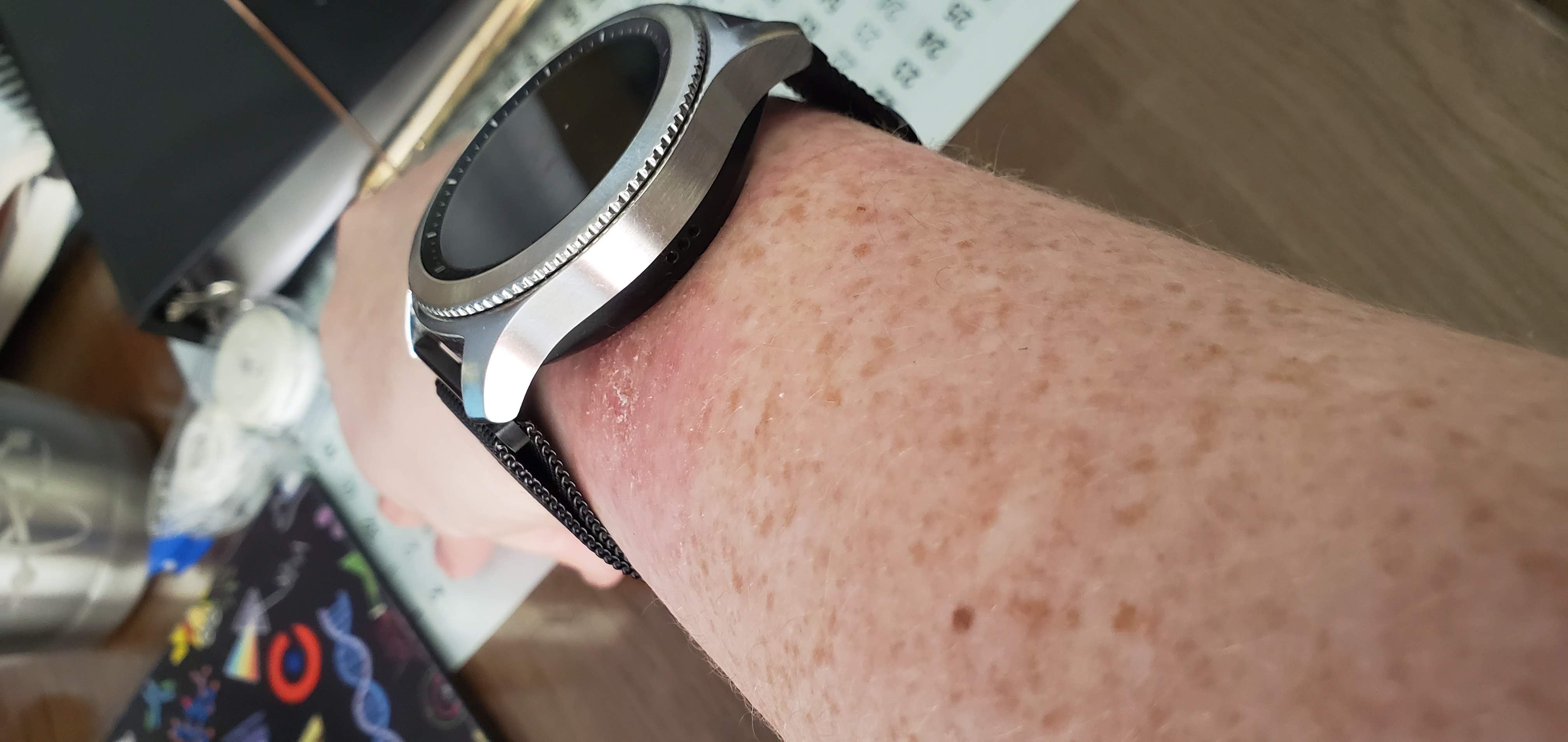 Horrible blisters/rash from Gear S3 watch Samsung Community