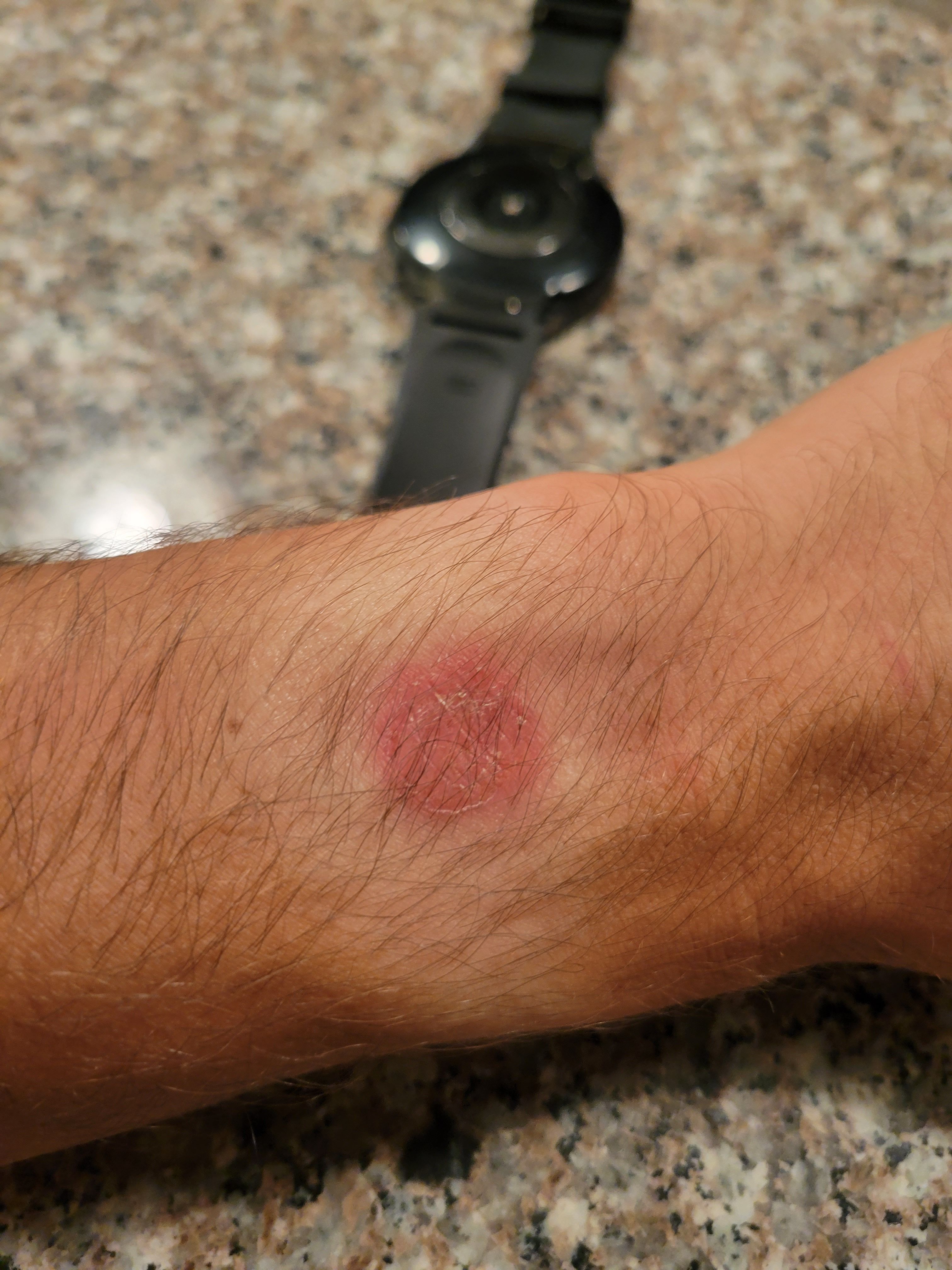 Samsung Watch 4 Classic Burning My Wrist Samsung Community